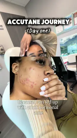 GUESS WHO’S STARTING ACCUTANE!!! I’m soooo excited, as a PCOS girly, my acne has always been a huge insecurity of mine. I’ve been struggling with hormonal acne since 2013, and have been researching accutane last year. Super excited to be one step closer to the clear skin I’ve always wanted. Follow me along to see my journey ✨💛 #accutane #fy #skincarejourney #callmecandacetv #hormonalacne 