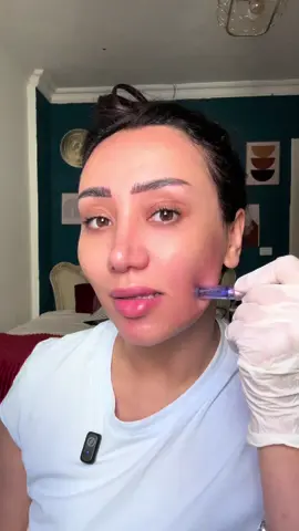 ⁨	الجلسه المقربه اللي قلبي جلسة Skin booster في البيت 💉♥️⁩ #skinbooster #سكين_بوستر #ديرما_بن #ديرما #dermapen 