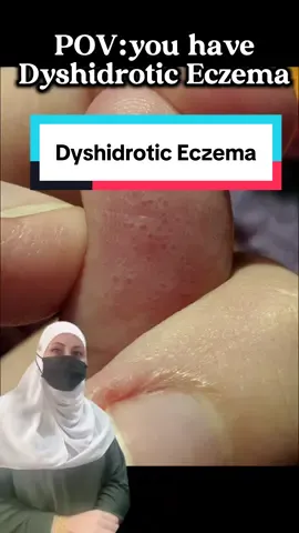 #eczema #skincare #allergy #dramira #skintreatment 