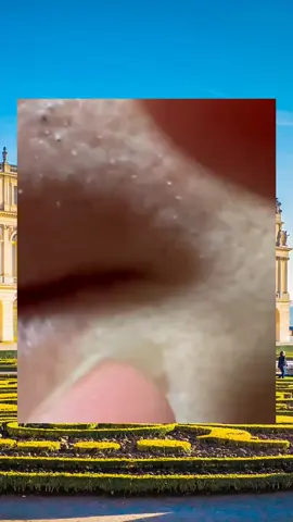 Amazing video #medical #asmr #pimples #tik_tok #satisfyingvideo 