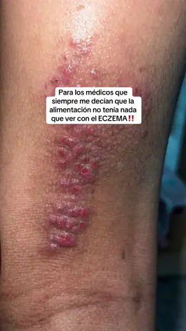 Cuando empecé a tratar la dermatitis de mi hijo, noté que algo no encajaba 🍎, sentía que la alimentación tenía mucho que ver, pero por meses me dijeron que no importaba, que solo usara esteroides 😔. Hasta que decidí hacer cambios en su dieta y junto a una rutina constante, su piel empezó a mejorar visiblemente 🥦. Su TSW y su eczema fueron controlándose hasta estabilizarse por completo por años, gracias a esos hábitos saludables. El año pasado, cuando volvió a tener un brote, lo primero que hice fue ajustar su alimentación nuevamente… y en semanas volvió a mejorar ✨. La alimentación sí influye, y es importante que los profesionales que te acompañen estén actualizados en un enfoque integral 🫶🏽. #eczema #dermatitis 