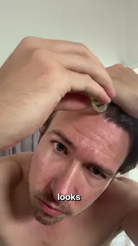 You can’t fake confidence… but you can regrow it 🔥 #alphainfuse #hairloss #hairtransformation #hairlossjourney #confidenceboost 