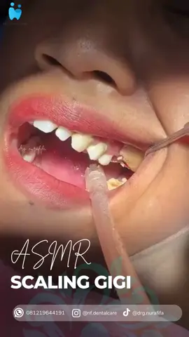 Jangan Lupa sikat gigi + cek ke dokter gigi setiap 6 bulan sekali ya..  #doktergigi #kepanjen #doktergigikepanjen #scalinggigi #scaling #perawatangigi #karanggigi 