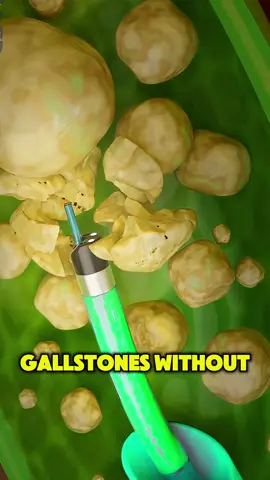 Gallstone Removal with Lithotripsy #GallstoneRemoval #Lithotripsy #GallbladderTreatment #3DMedicalAnimation #MedicalAnimation