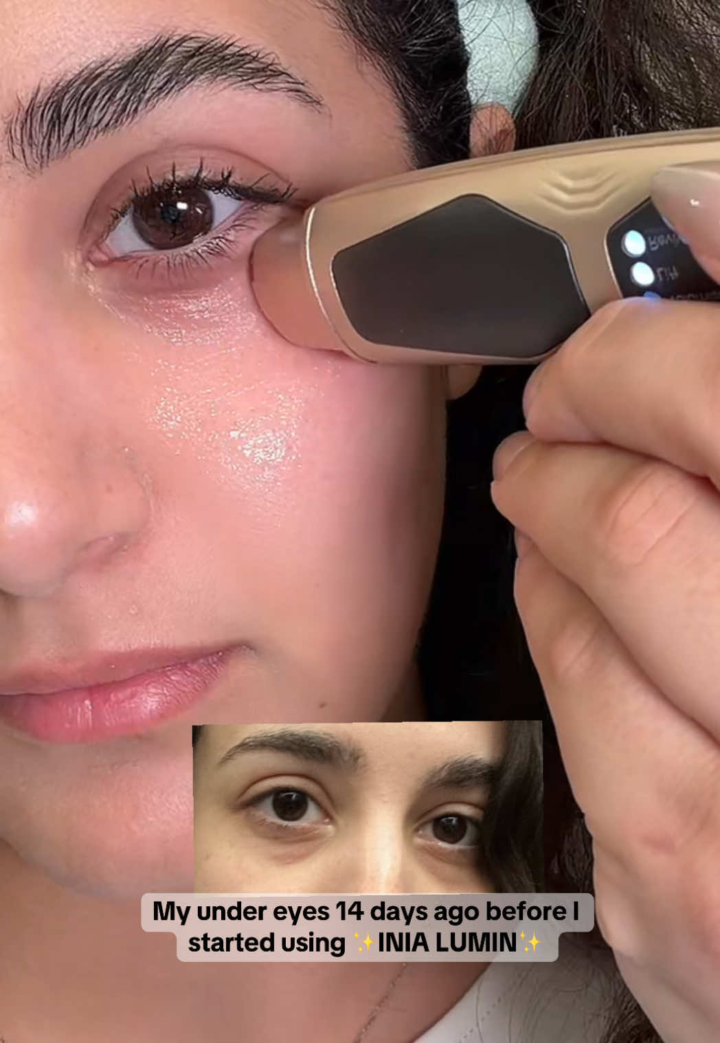 Puffy eyes? Dark circles? Fine lines creeping in? This @inia_beautycare Lumin eye tool has been my game changer! ✨ I used it for 14 days, 3 minutes a day, smoother, tighter, more awake eyes 😍 Red light, microcurrent & gentle heat that doesn’t hurt, obsessed! #Inia #TikTokShopCreatorPicks #undereyebags  #RedLightTherapy #AntiAgingRoutine