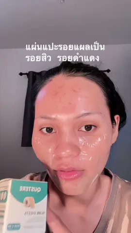 #แผ่นแปะรอยแผลเป็น #แผ่นแปะแผลเป็นแผลเป็นนูนแผลคีย์ลอย #รอยสิว 