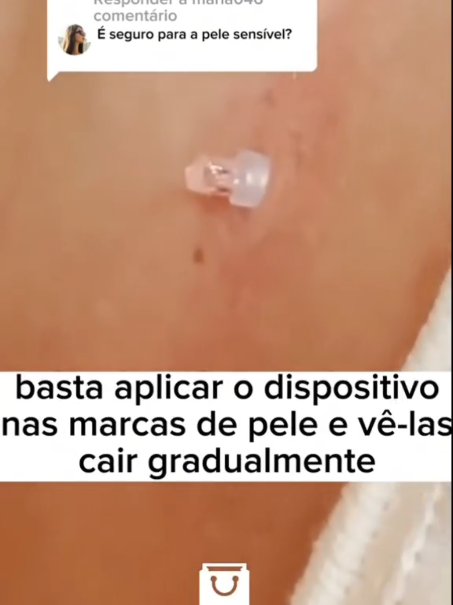 🌿✨ Cuide da sua pele com precisão e segurança! O Dispositivo Removedor de Marcas YUEN 2–8mm ajuda na remoção de pequenas e grandes marcas, acompanhando faixas específicas para cada tipo de tratamento. Prático, eficaz e fácil de usar em casa.  ✨ Confira esse achado incrível na Shopee! ✨ 👉 Copie e cole na barra da Shopee para garantir o seu: BRV-VYA-NHR #CuidadosComAPele #TratamentoFacial #PeleSaudável #BelezaEmCasa #RemoçãoDeMarcas