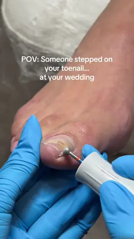 For the info: this is not a regular repair with Acrylic, this is professional reconstruction by Nanoflex system as a trained and certified by NASP school  #russianmanicure #toes #toenailreconstruction #nailrepair #nailsaustin 