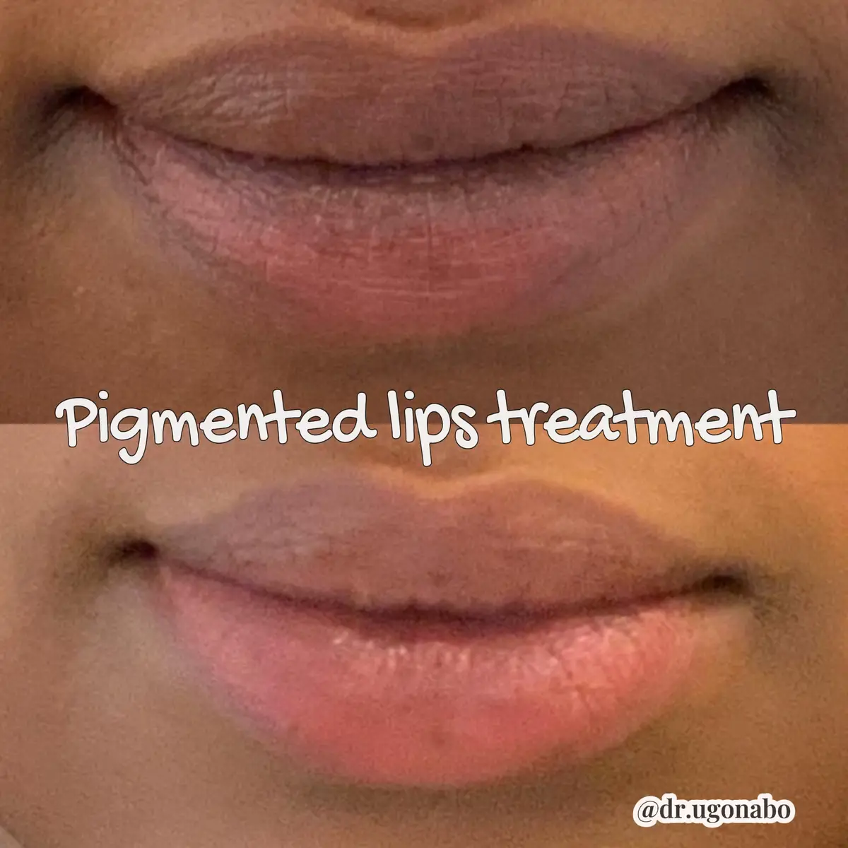 Lips treated by Dr. Ugonabo in New York City