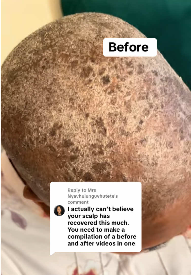 Replying to @Mrs Nyavhulunguvhutete  Aloe First Spray and Aloe Vera Gelly are the best natural scalp care combo. They hydrate, soothe, fight dandruff while calming seborrheic dermatitis and eczema. Perfect for shaved heads that need gentle care and long lasting moisture. #AloeVeraBenefits #HealthyScalp #DandruffTreatment #EczemaRelief #SeborrheicDermatitis