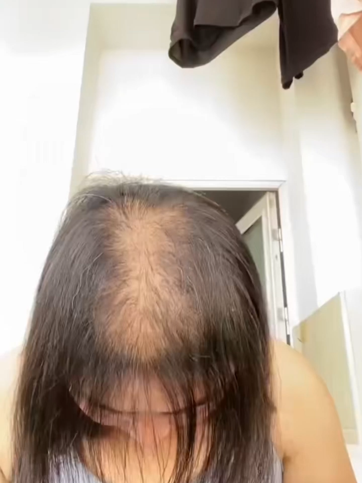 No more hair l0ss, no more ba.ldness after weeks with #fegplus #hairserum Link in bio