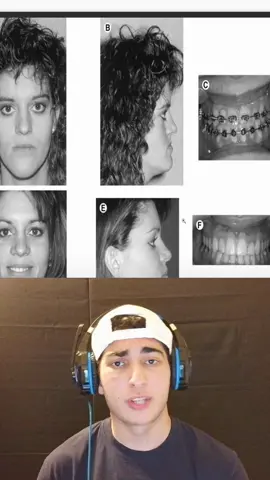 Lefort 2 review #bp #looksmax #looks 