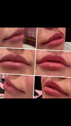 OBSESSSEEDDD 💕👄💉🔥 @June Seventh Boutique @GlambyK @BabeHQ 💕 @Isabella Jolee McNeely @StyledBySasha @EvolysseByEvolus #fyp #trending #viralvideo #lipfiller 