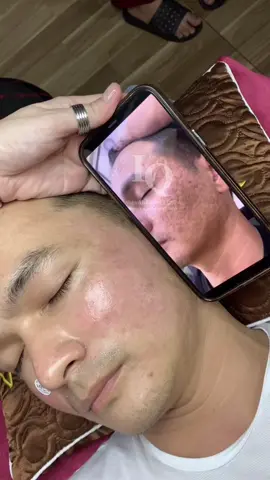 Cập nhật da sẹo #chamsocdamun#chamsocdaseo#chamsocdanam#tanbinh#Lqspa&academy