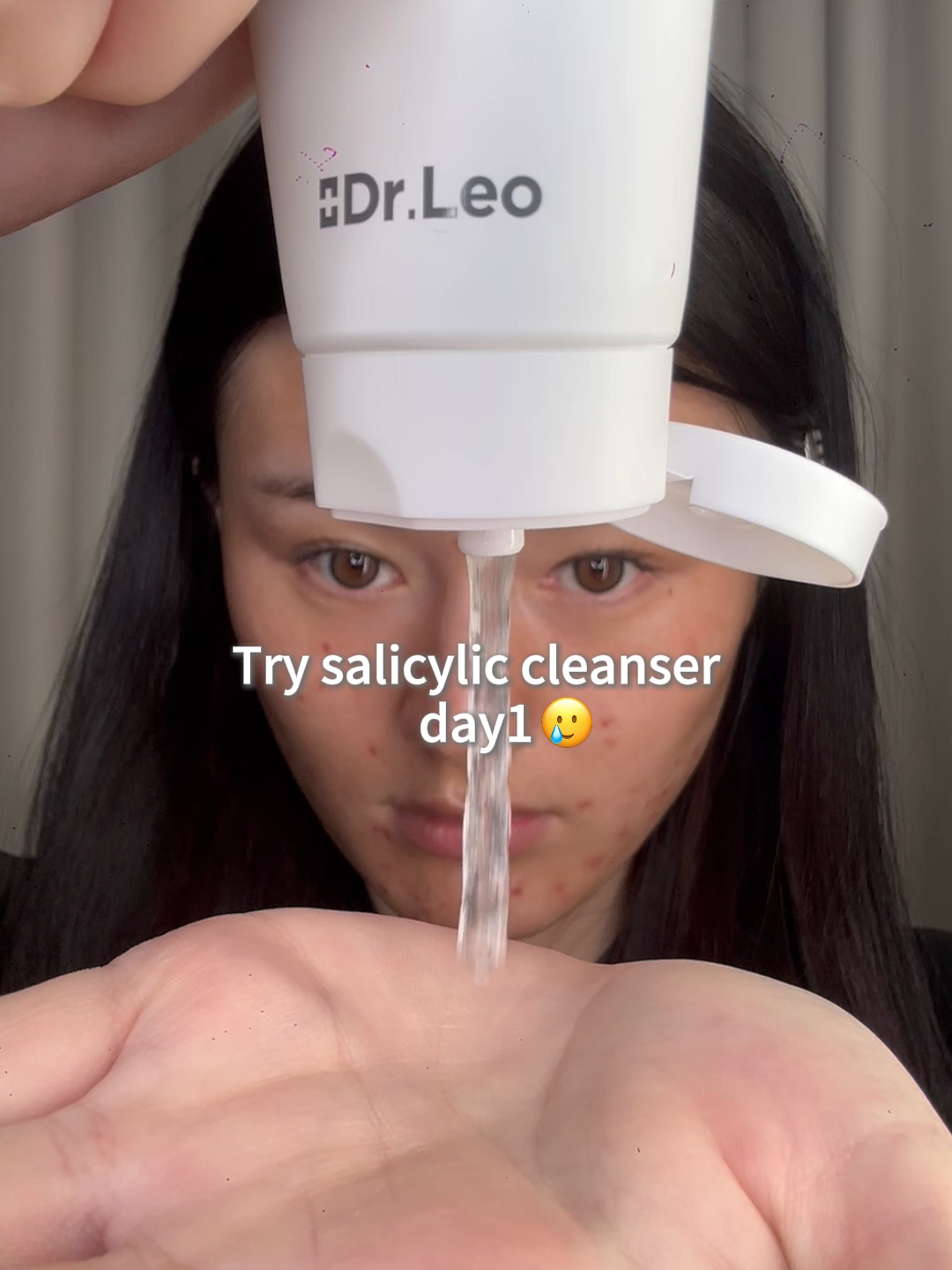 Percaya nggak dulu aku jerawatan? 😱