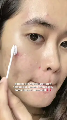 kunci dari segala problem jerawat, ya cuma obat totol jerawat dr leo yg jd andalan aku dr dulu 🫶🏻😍 #drleo #obattotoljerawat #acnedryinglotion #skincareroutine #acnefighter 