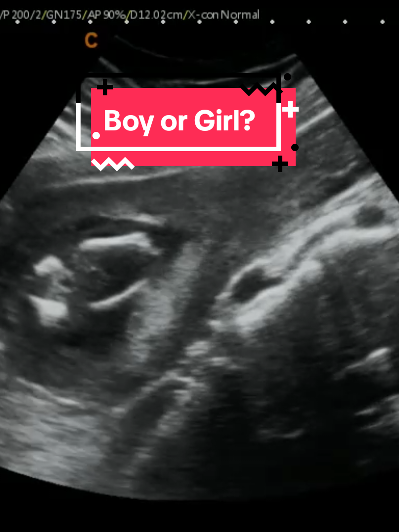 What does this look like to you? Boy or Girl? #heybabymobile #genderrevealultrasound #pregnancyultrasound #rochesternyultrasound #16weeksPregnant www.HeyBabyMobile.com 