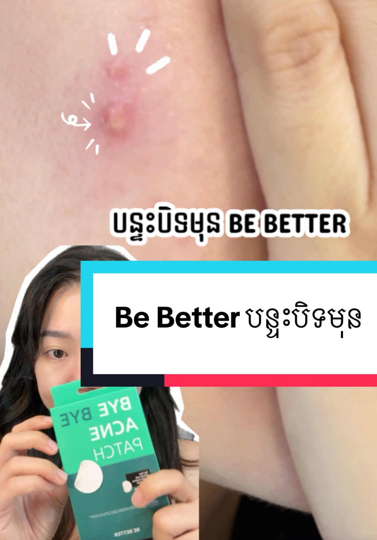 កើតមុនដល់ចាស់ម៉ងខ្ញ៉ំ តែព្យាយាមក៉ំឲ្យស្នាមធំ និង ជ្រៅ ✨💓ចឹងឆាប់បាត់ទៅវិញ 💓BE BETTER Pimple patch ផលិតតនៅកូរ៉េ 🇰🇷💯 #fyp #yibeautystore #skincare 