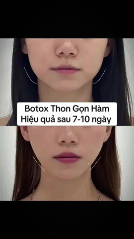 thon gọn vline chi với 1 lần t.iêm#fillerbotoxnhatban🇯🇵 #nhận_tiêm_tận_nhà_không_phát_sinh_chi_phí #vairalvideo #môi_cằm_botoxthongọnhàm_nhấnmí_mũichỉcolagen 