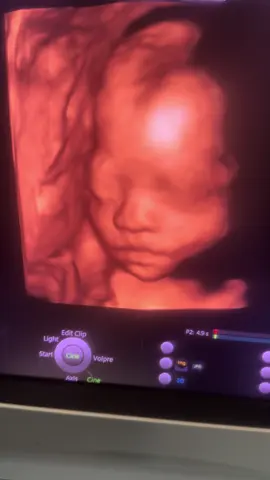 Siêu âm thai 26 tuần #bsdiemkieusanphukhoa #benhvienhoanmycuulong #hoanmycuulong #sanphukhoacantho 