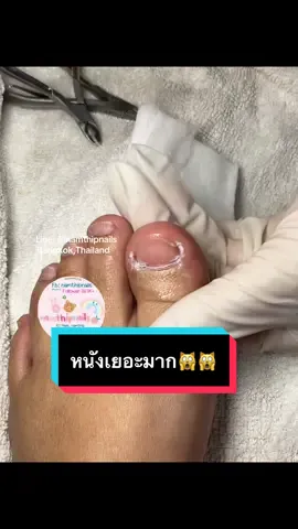 💓 #namthipnails #ตัดเล็บขบ #ตัดหนัง #ทำเล็บ #ร้านตัดเล็บขบ      Fb : namthipnails  Line : @namthipnails