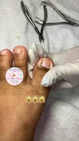 💓 #namthipnails #ตัดเล็บขบ #ตัดหนัง #ทำเล็บ #ร้านตัดเล็บขบ      Fb : namthipnails  Line : @namthipnails