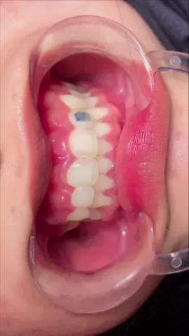 Diamonted (permata gigi) 20k😍#a4 #permatagigi #semuaorang #imabehelsudiang #gorsudiang📍 