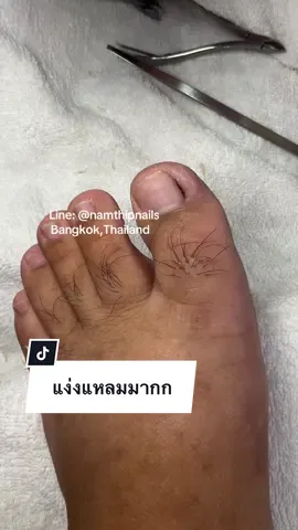 💓 #namthipnails #ตัดเล็บขบ #ตัดหนัง #ทำเล็บ #ร้านตัดเล็บขบ      Fb : namthipnails  Line : @namthipnails
