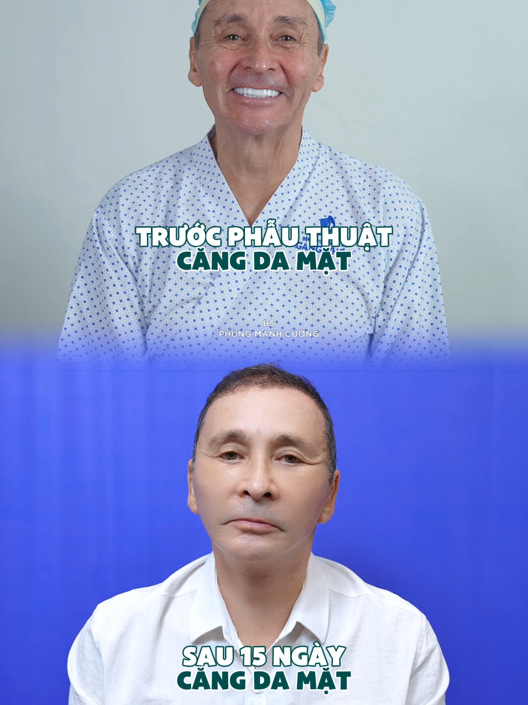 Anh khách hàng phi công về hưu quyết định đi căng da mặt để có ngoại hình trẻ trung sau 15 ngày #cangdamat #facelift #bacsiphungmanhcuong #tiktokviral