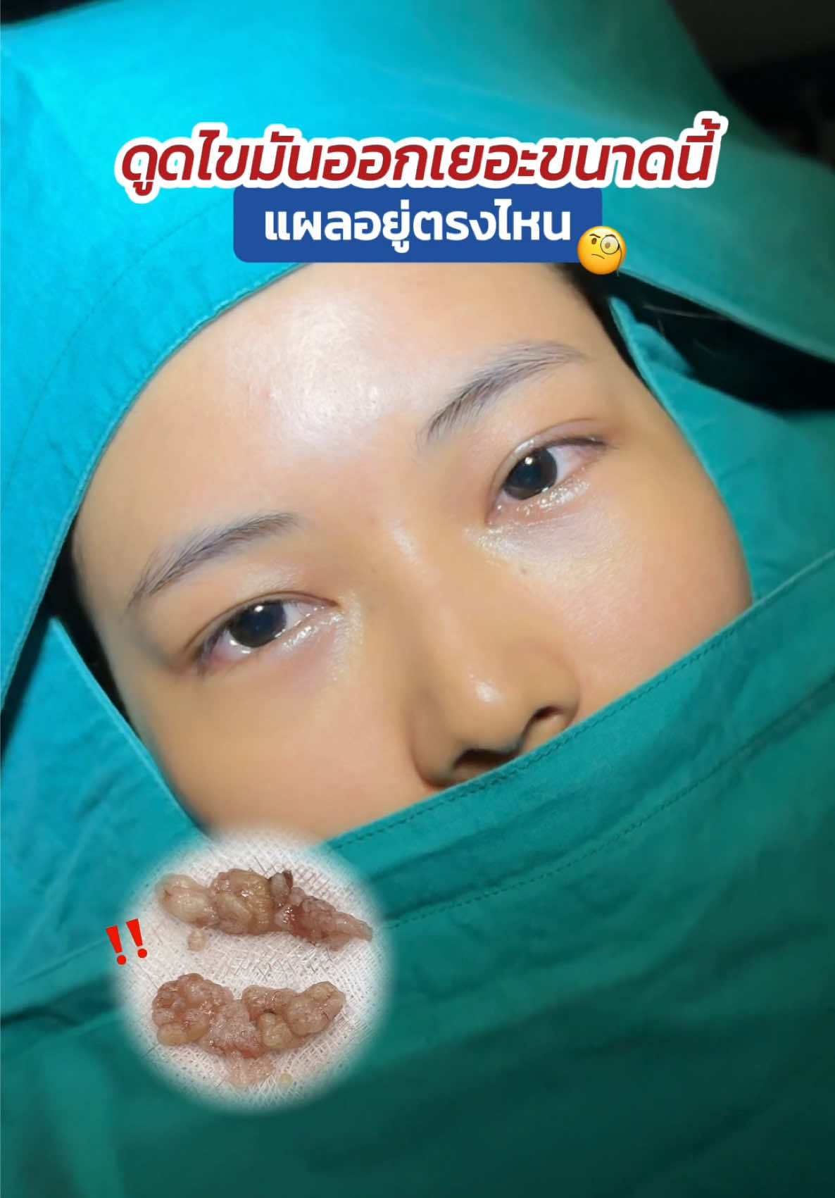 ดูดไขมันออกเยอะขนาดนี้ แผลอยู่ตรงไหน 🧐 #กำจัดถุงใต้ตาแผลใน #skyclinic #หมอสกาย #จักษุแพทย์ #ทําตาที่ไหนดี 