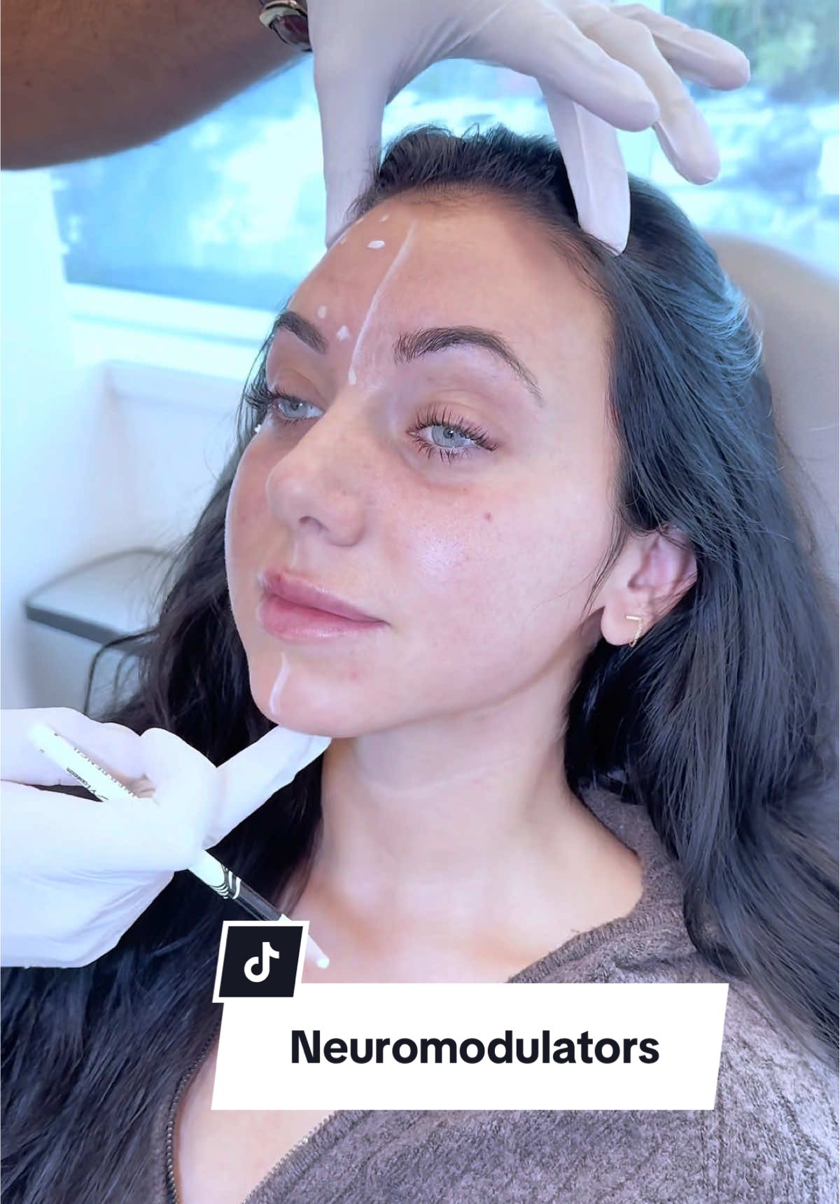 Botox is one of the most popular non-surgical treatments for softening lines and preventing new ones from forming. It works by relaxing specific facial muscles that cause wrinkles from repeated movement. Common treatment areas include: ✨ Glabella (between the brows): Smooths frown lines or “11s” ✨ Forehead: Softens horizontal lines for a more relaxed look ✨ Crow’s feet: Reduces fine lines around the eyes ✨ Chin: Improves dimpling or “orange peel” texture ✨ Neck bands (platysmal bands): Helps create a smoother neck contour ✨ Under the nose: Lifts a downturned nasal tip or softens upper lip pull When performed with precision, Botox enhances your natural features while maintaining expression and balance. 📍Woodbury, LI 📍Manhattan, NY