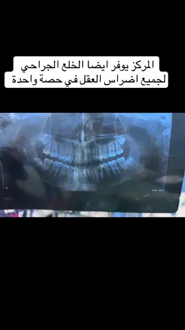 #LIVEIncentiveProgram #ترند_تيك_توك #اسنان #تخدير #غاز 