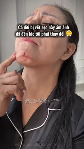Cả đời tôi bị vết sẹo này ám ảnh. #actiscar #moseotainha #kemmoseo #triseo 