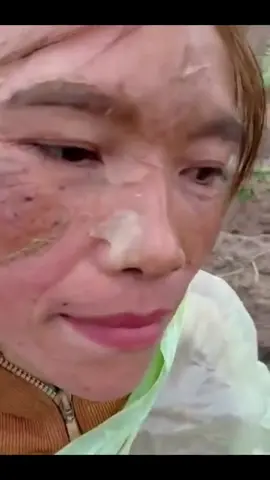 Da c khách trồng khoai sau 4 ngày xử lý kỹ thuật!   #videoviralシ  #xuhuongfb  #videoreel  #spa 