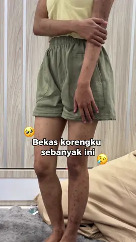 (SAVE AND SHARE) Pernah nggak sih ngerasa insecure cuma gara-gara bekas luka?😢 Aku juga dulu gitu. Tapi ternyata, semua bisa membaik asal konsisten dan sabar 🤎 Sekarang giliran kamu buat mulai rawat kulitmu bareng Ciara Chamomile ✨ #ciara #ciaraindonesia #fyp #bekasluka #bodycare     