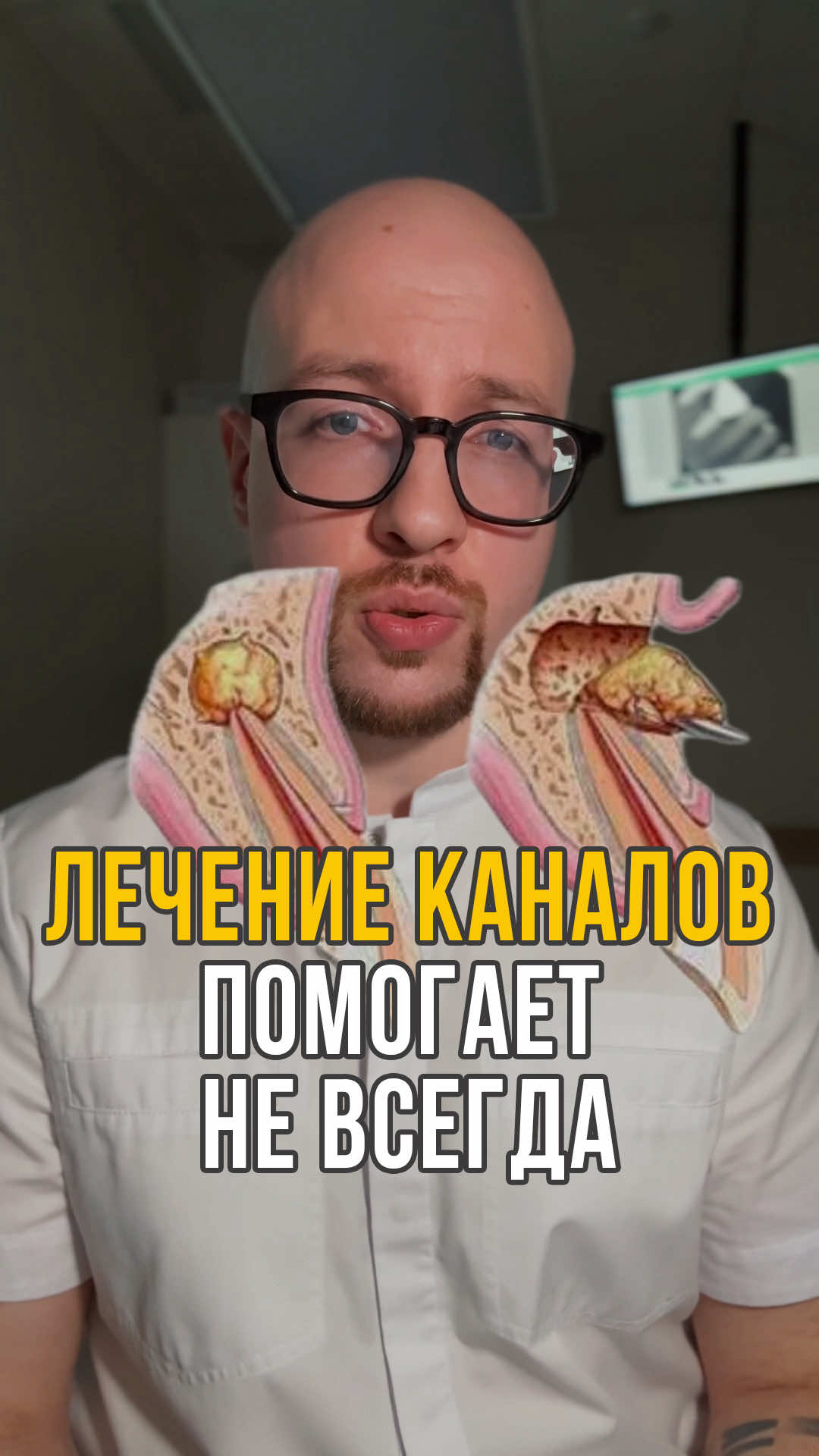 И это всё еще не повод удалять зуб, вы не поверите 😁