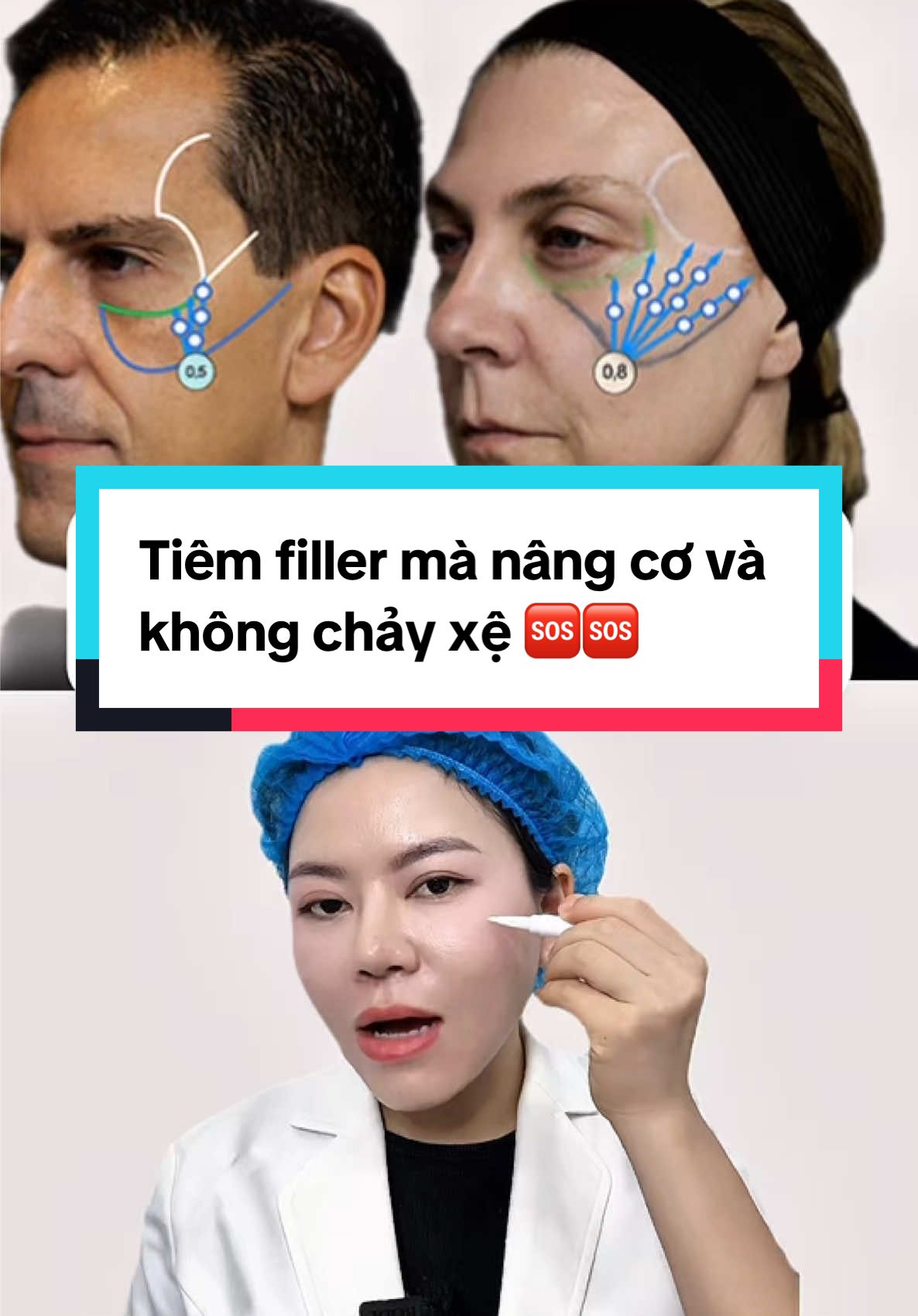 Tiêm filler có gây chảy xệ không ? #bstranoanh #tiemfiller #fillerinjection #midface #mdcodes 