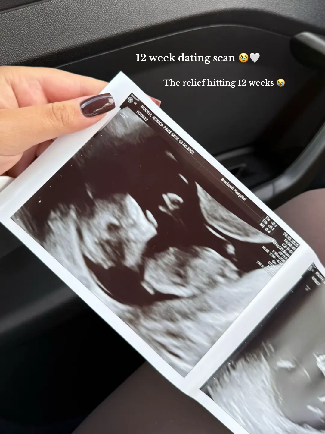 #pregnant #pregnancy #12weekspregnant #ultrasound #firsttrimester 