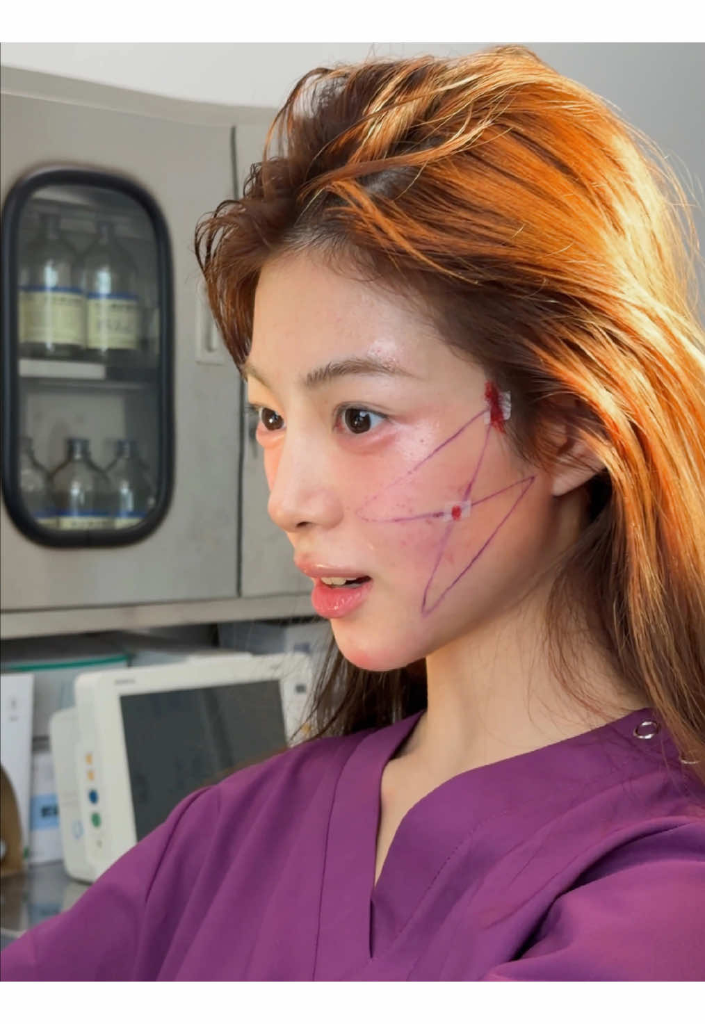 She travels the world for a living, but lately, her face couldn’t keep up with her spirit — tired eyes, sagging cheeks, deep lines from endless flights and stress. ✈️ This time, she stopped chasing sunsets and came to Shanghai to chase herself. After 9D lifting, her face looks light, refined, and full of energy again — like she finally caught her glow back. 🌅 #9DFacelift #FacialRejuvenation #NaturalBeauty #LiftAndTighten #YouthfulVibes     