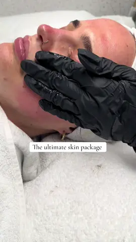 ✨The ultimate skin package with the latest technology combines powerful treatments for enhanced skin health and appearance: 1. Hydra Facial: Cleanses, exfoliates, extracts impurities, and hydrates using customized serums. 2. Microneedling: Stimulates collagen production with hyaluronic acid, improving skin texture and elasticity. 3. Chemical Peel: Applied after microneedling to further exfoliate and improve skin tone, often accompanied by a hydrating face mask. This comprehensive approach promotes healthy, glowing skin through deep cleansing, hydration, collagen stimulation, and exfoliation. Consult a skincare professional to tailor the treatments to your specific needs. #skin #skincare #blessed #Godbless 