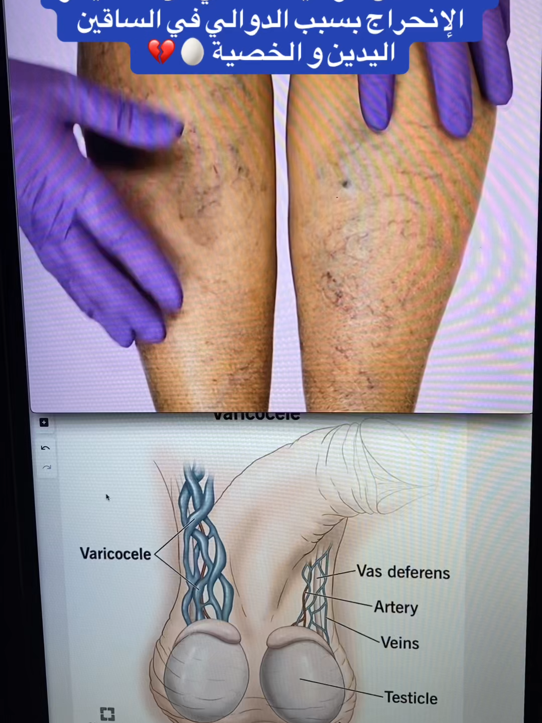 #دوالي_الخصيه #الدوالي #الدوالي_العنكبوتيه #الدوالي_الدوالي #الرياض_الان #استشارات_طبية #دكتوره_رحمه_الغيلي #معلومات_طبية #رحمة_الغيلي #تيك_توك_عرب #مكة_المكرمة #الطائف_الان #الدمام_الخبر_الشرقيه #الدوالي_الوريديه_أسبابها_وأعراضها #saudiarabia🇸🇦 #اكسبلور #93saudinationalday #videoviral