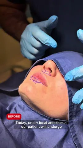 In this video, we perform a Bullhorn Lip Lift — a surgical procedure that shortens the distance between the nose and the upper lip, creating a more youthful and defined smile.#aestheticsurgery #plasticaclinic #naturalbeauty #lipsbydrorkhan #liplift 