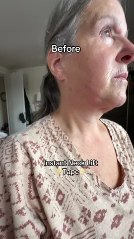@Skinnies InstantLifts #necklift #facelift #motherofthebride #weddingguestdress #facialbalancing 
