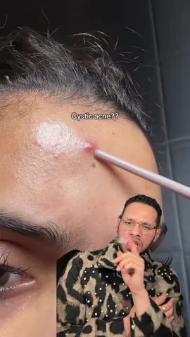 Cystic acne gone #skincare #beauty 