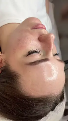 ဆဝက်ခြံ၊အမဲစက်၊ဝက်ခြံပျောက်ချင်မှသုံး#ဝက်ခြံပျောက်ခြင်သူများ #teပျားမျက်နှာသစ် #ခိုင်ဖူး 