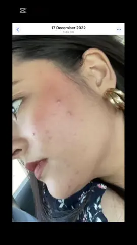 life w acne, iykyk . #acnetreatment #acneproneskin #hormonalacne #acnestruggles #acnepositivity 