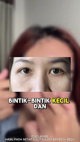 Bintik kecil diarea mata itu syringoma! Segera atasi sekarang‼️ #syringoma #leikaskincare #skincaresyringoma #gajiansale 