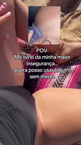 Por anos, essa era a parte do meu corpo que eu mais escondia… hoje, é onde eu mais me sinto livre.” #clareadordemancha #virilhaclara #autoestima  #transformacaofeminina 