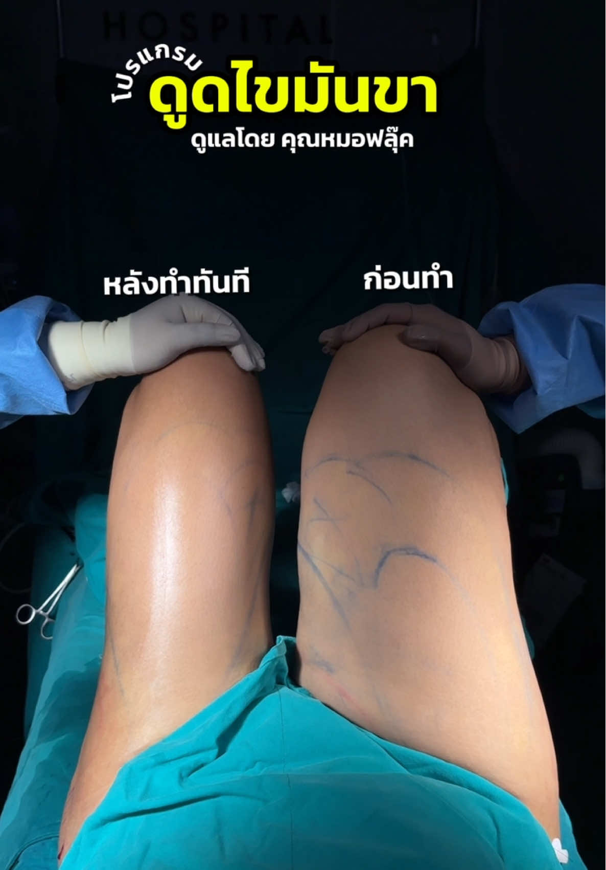 ✨ ดูดไขมันขา บอกลาขาเบียด เห็นความต่างชัดตั้งแต่ครั้งแรก 💖  #หมอฟลุ๊คมาสเตอร์พีช#ดูดไขมัน#ขาเบียด#โรงพยาบาลมาสเตอร์พีช#มาสเตอร์พีช 