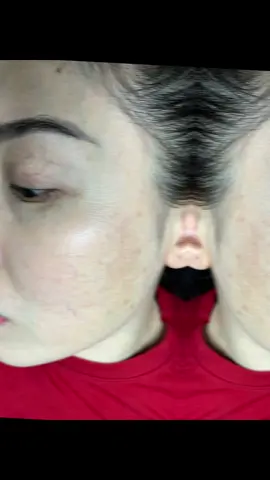 Nám mảng nội tiết da mỏng yếu , 1 buổi chuyên sâu và 2 buổi phục hồi#nám_tàn_nhang_mụn_thâm #nám_tàn_nhang #námchânsâu #nám_sạm #nám_sạm 